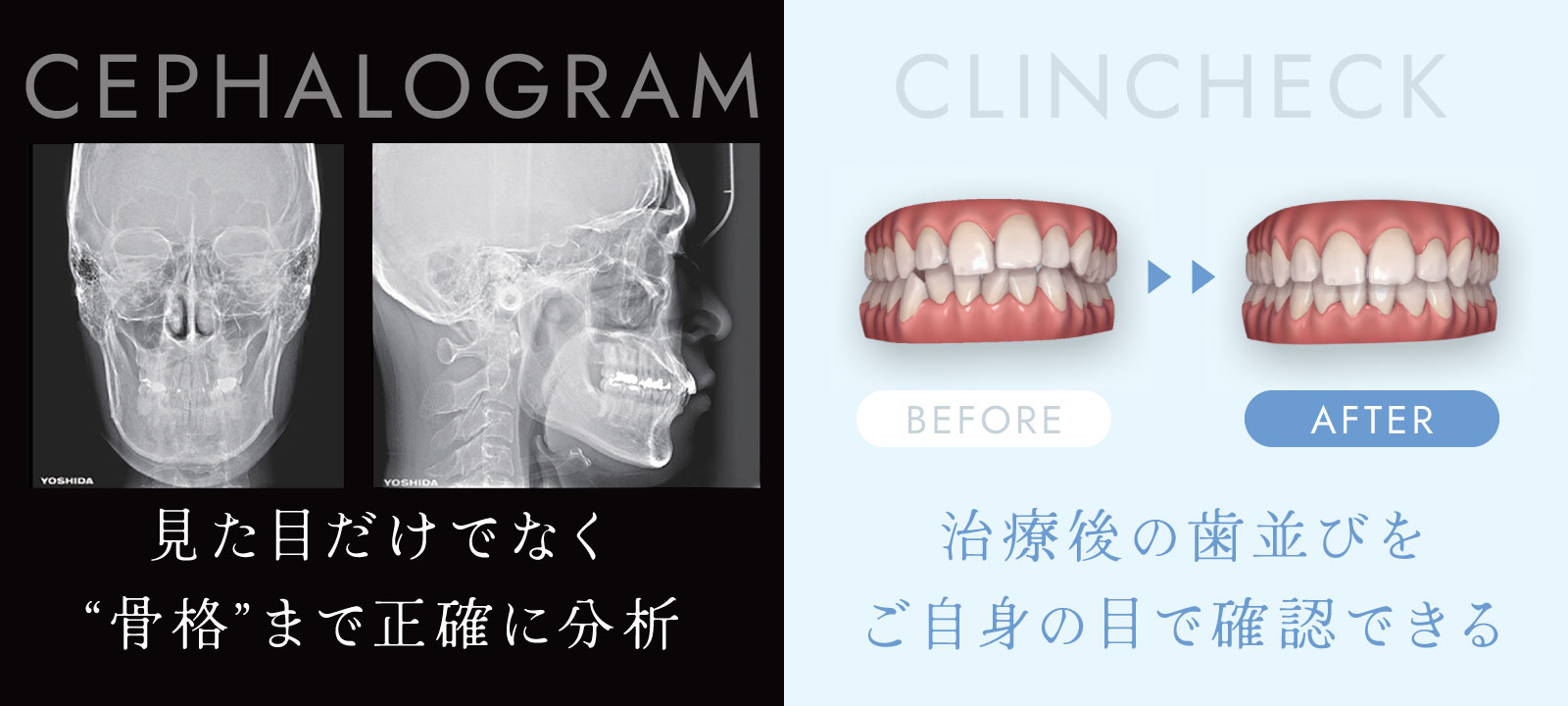 見た目だけでなく“骨格”まで正確に分析/治療後の歯並びをご自身の目で確認できる