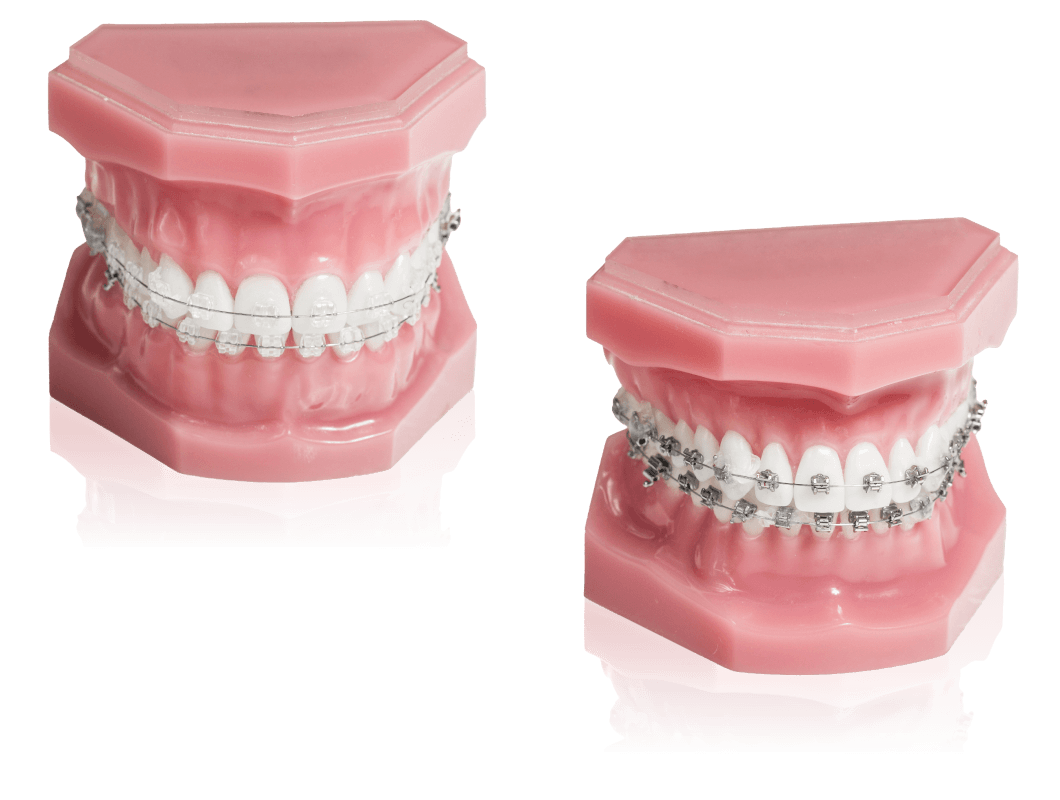 ブラケット矯正